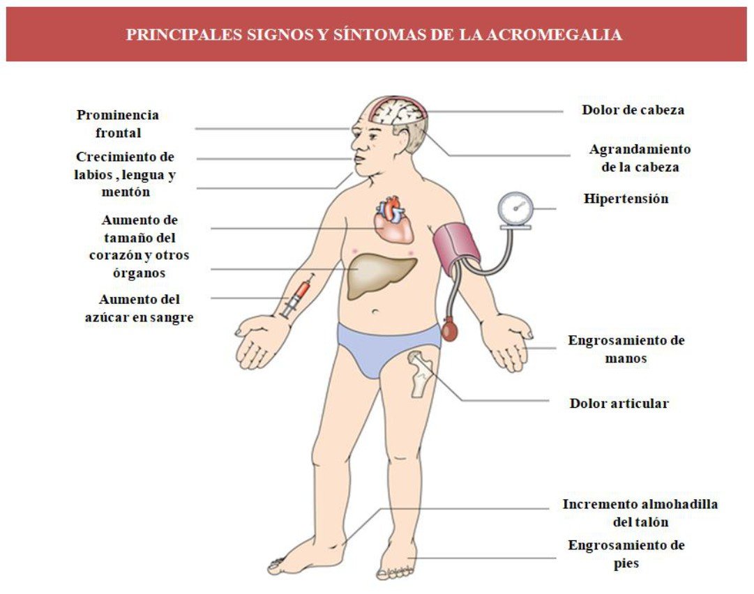 Acromegalia Enfermedad Rara Con Presencia En M Xico Mni Noticias